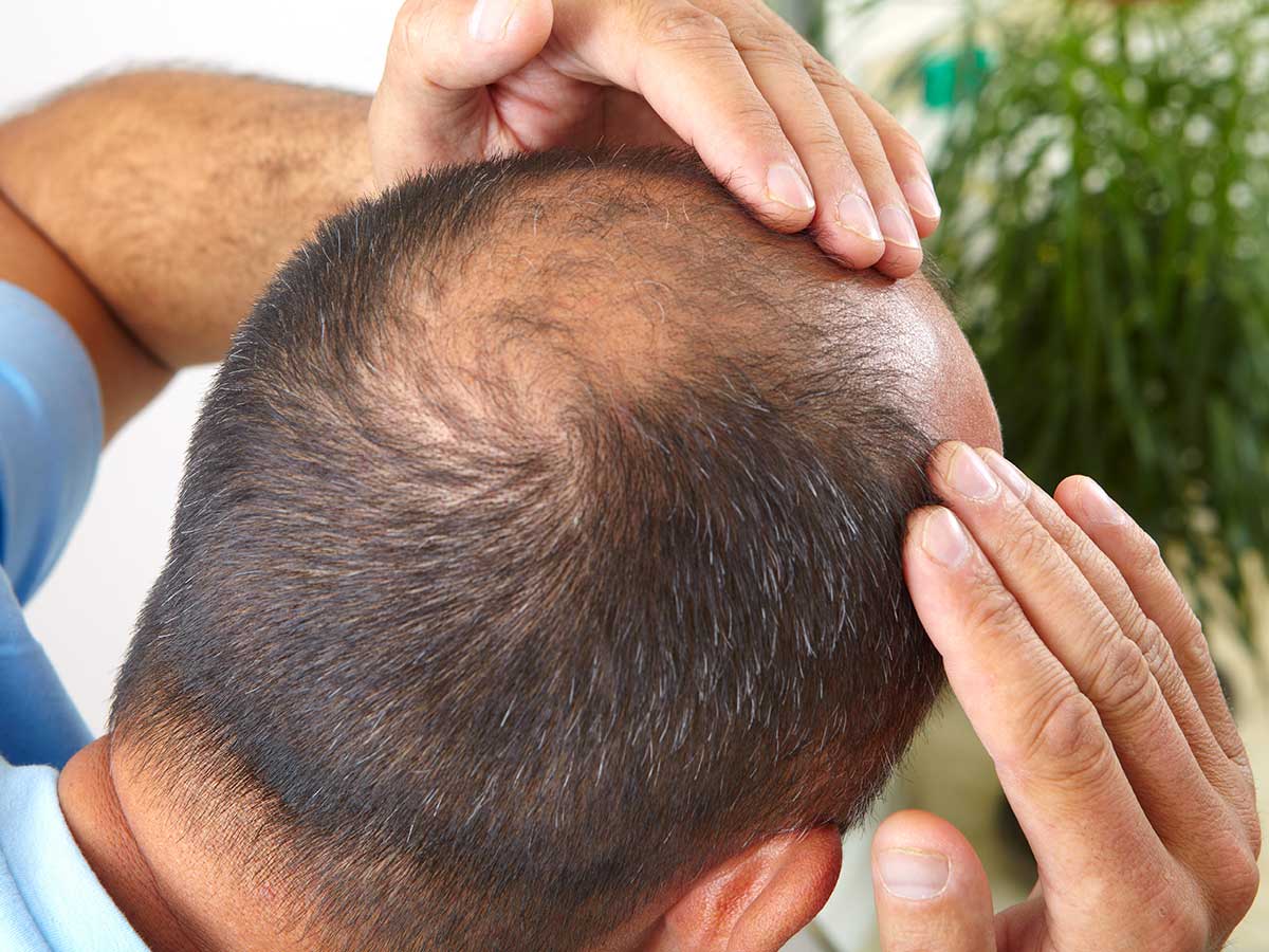 PRP capelli trattamento per alopecia a Lugano